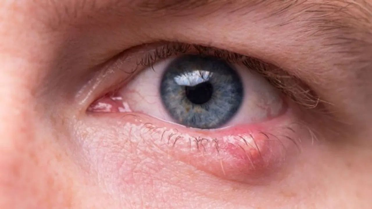 চোখে আঞ্জনি কেন হয়? হলে কী করবেন? চোখে আঞ্জনি কেন হয়? হলে কী করবেন?