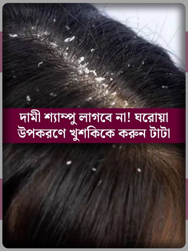 ঘরোয়া টোটকায় টাটা বলুন খুশকিকে! রইল সেই টিপস ঘরোয়া টোটকায় টাটা বলুন খুশকিকে! রইল সেই টিপস