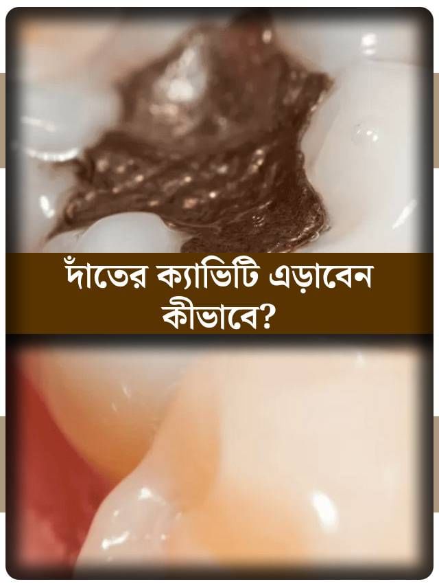 ক্যাভিটির সমস্যায় ভুগছেন? মুক্তির উপায় জানেন? ক্যাভিটির সমস্যায় ভুগছেন? মুক্তির উপায় জানেন?