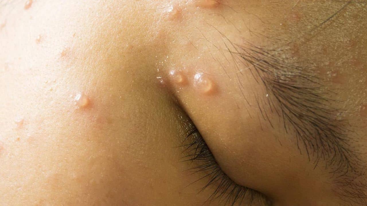 এটা খেলেই পক্স উধাও! কাজ করবে ম্যাজিকের মতো