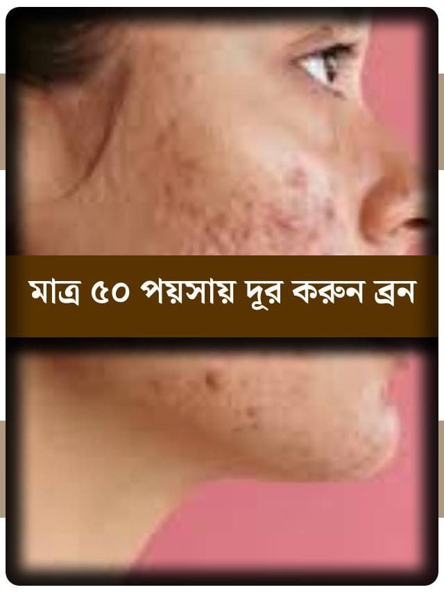 মাত্র ৫০ পয়সা খরচ করেই ১৪ দিনে সারান মুখের সব ব্রন! জনুন কীভাবে? মাত্র ৫০ পয়সা খরচ করেই ১৪ দিনে সারান মুখের সব ব্রন! জনুন কীভাবে?