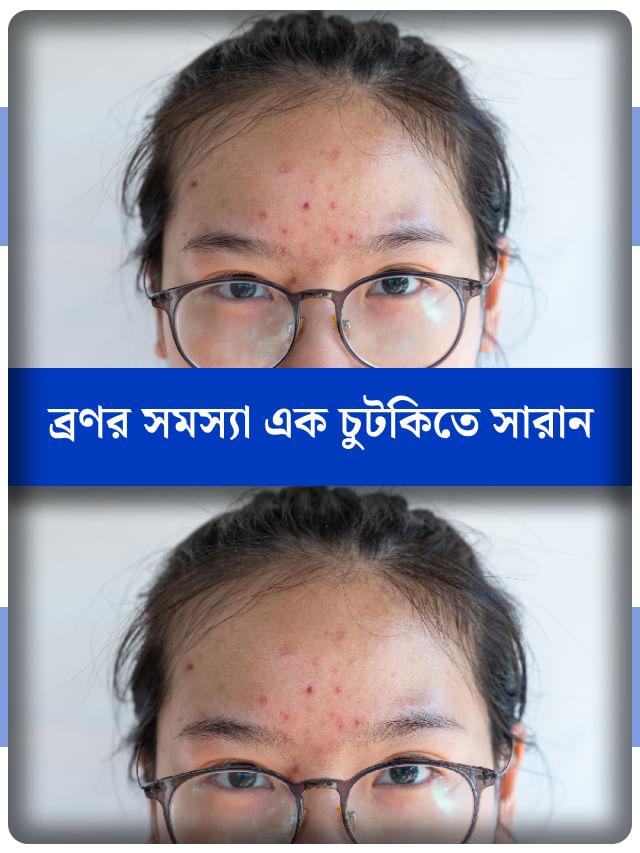 কপাল ভর্তি ব্রণর সমস্যায় নাজেহাল? এই টিপস ব্যবহার করে আরাম পান কপাল ভর্তি ব্রণর সমস্যায় নাজেহাল? এই টিপস ব্যবহার করে আরাম পান