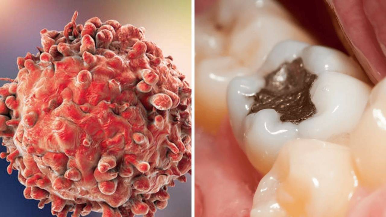 Dental Health and Cancer: দাঁতের ক্যাভিটি থেকে সত্যি ক্যানসার হতে পারে? কী বলছেন বিশেষজ্ঞরা?