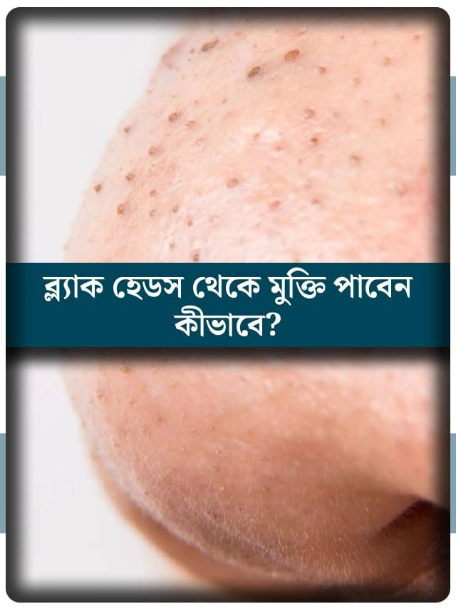 ব্ল্যাক হেডসে ভরেছে থুতনি-নাক? কী করলে মিলবে মুক্তি?