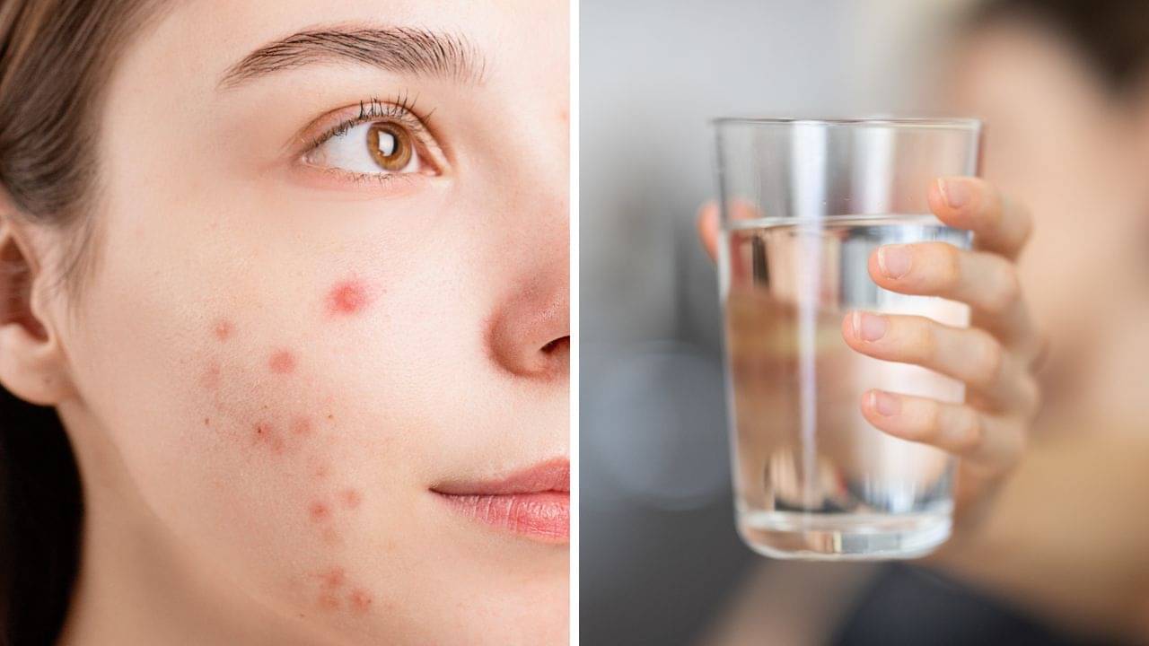 Acne Free Skin: ব্রণর জন্য বিরক্ত? শুধু জল খেয়েই ত্বকের এই সমস্যাকে হাজার কদম দূরে রাখতে পারেন