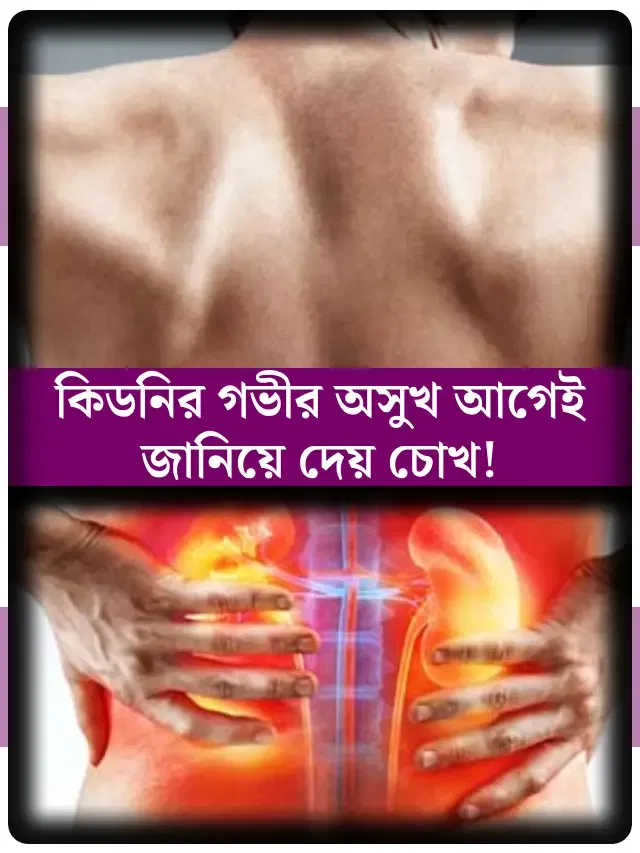 দৃষ্টিশক্তি কম দেখা মানেই চোখের সমস্যা নয়, হতে পারে কিডনির জটিল অসুখও! বুঝবেন কীভাবে?