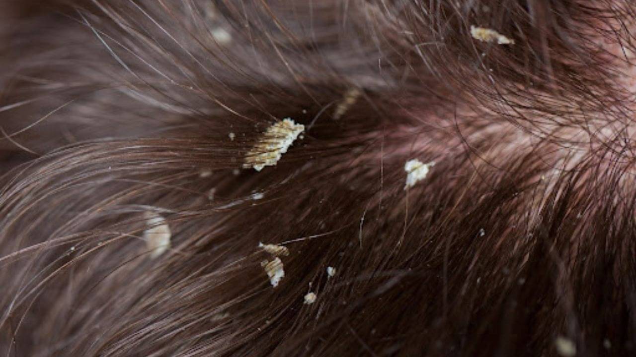 Oily Skin and Dandruff Problems: তৈলাক্ত ত্বকে বারবার ফিরে আসে খুশকির সমস্যা! স্থায়ী সমাধানটা কী?