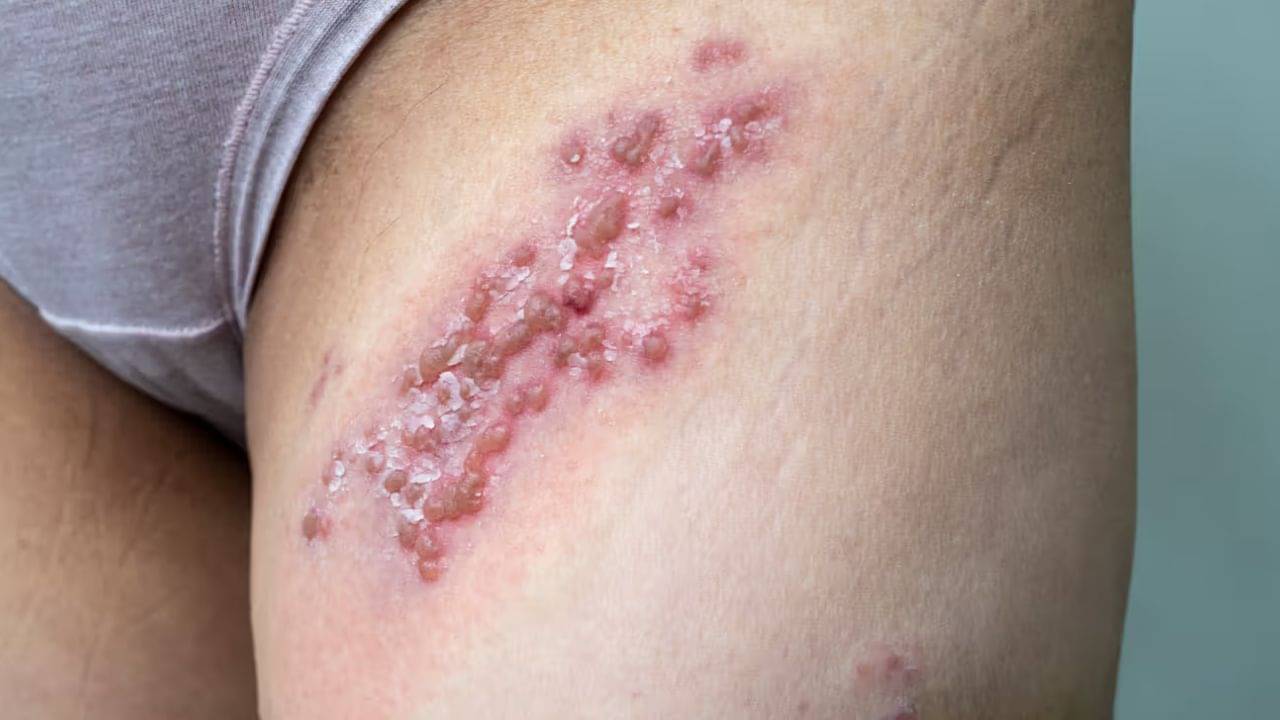 জেনেটাইল হারপিস, রোগটা আসলে কী? জানলে আঁতকে উঠবেন