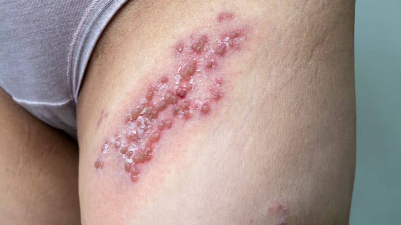 জেনেটাইল হারপিস, রোগটা আসলে কী? জানলে আঁতকে উঠবেন জেনেটাইল হারপিস, রোগটা আসলে কী? জানলে আঁতকে উঠবেন