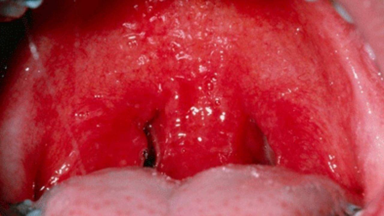 Pharyngitis: সকালে ঘুম থেকে উঠলেই সর্দি জমে থাকে গলায়? ফ্যানেনজাইটিস কিনা বুঝবেন কীভাবে?