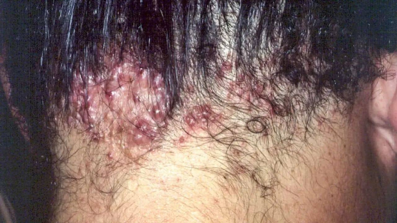 Acne: মাথার ত্বকেও হতে পারে ব্রণ! কী করলে মিলবে মুক্তি?