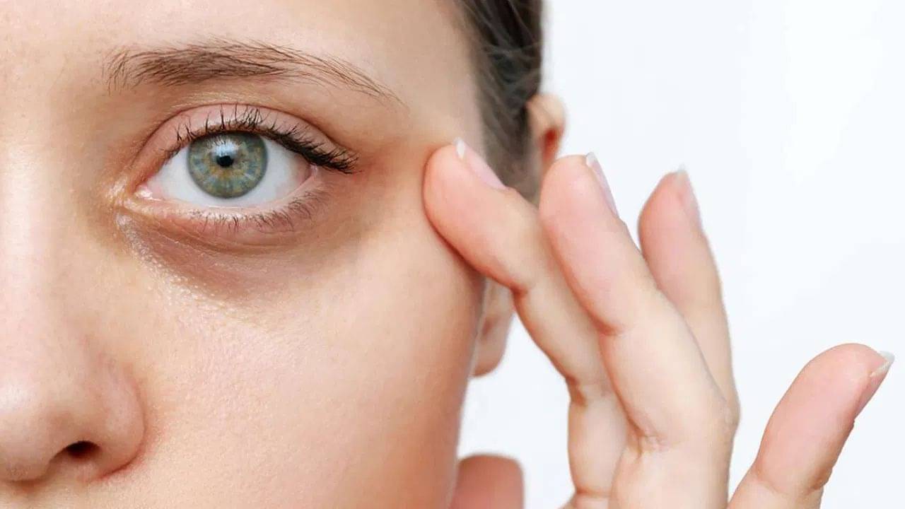 Dark Circles: দামী প্রোডাক্ট নয়, চোখের তলার কালিকে টাটা করুন ঘরোয়া উপায়েই