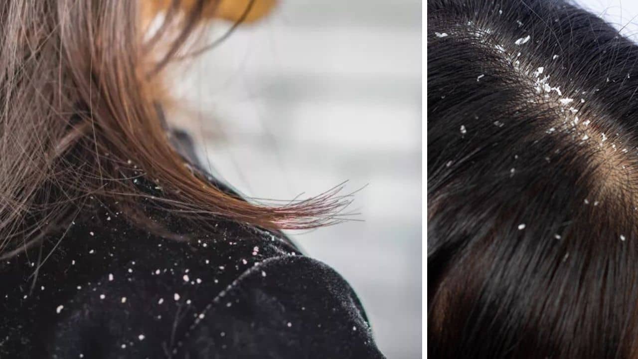 Dandruff Problem: এই ৫ ভুলেই খুশকি জাঁকিয়ে বসে, না জানলেই পড়বেন বিপদে!