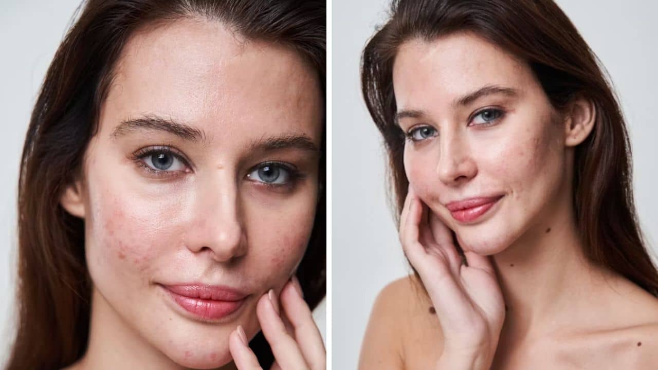 Acne: এক ফোঁটা লাগালেই ব্রণ গায়েব! ঠাকুরঘরেই রয়েছে সেই ম্যাজিক উপাদান