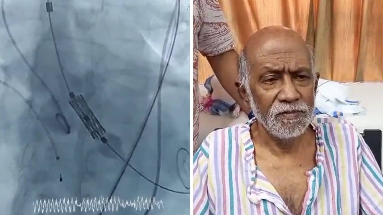 Burdwan Hospital: সরকারি হাসপাতালে মিরাকল, বুক না কেটেই বদলে দেওয়া হল ভালভ, লাগল না কোনও টাকা