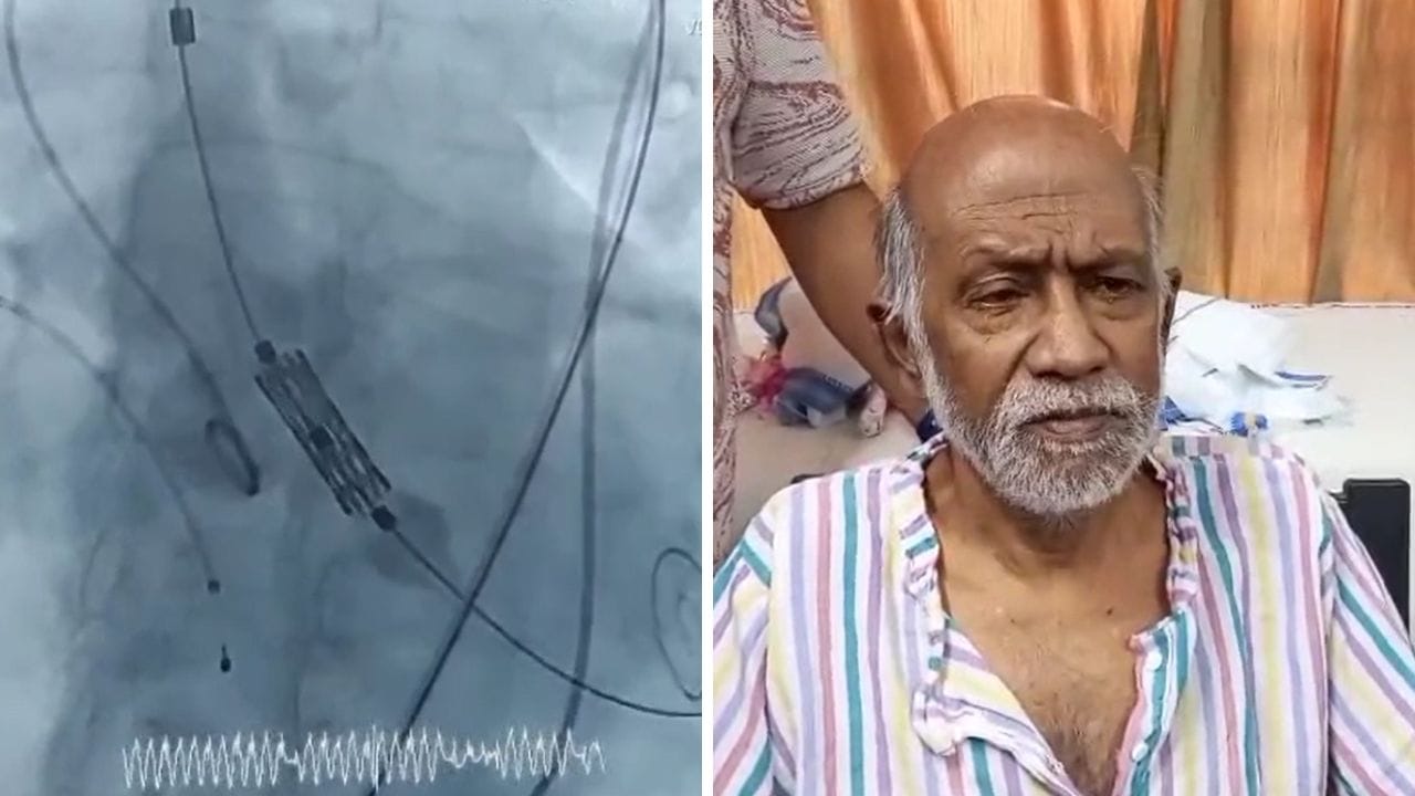 Burdwan Hospital: সরকারি হাসপাতালে 'মিরাকল', বুক না কেটেই বদলে দেওয়া হল ভালভ, লাগল না কোনও টাকা Burdwan Hospital: সরকারি হাসপাতালে 'মিরাকল', বুক না কেটেই বদলে দেওয়া হল ভালভ, লাগল না কোনও টাকা