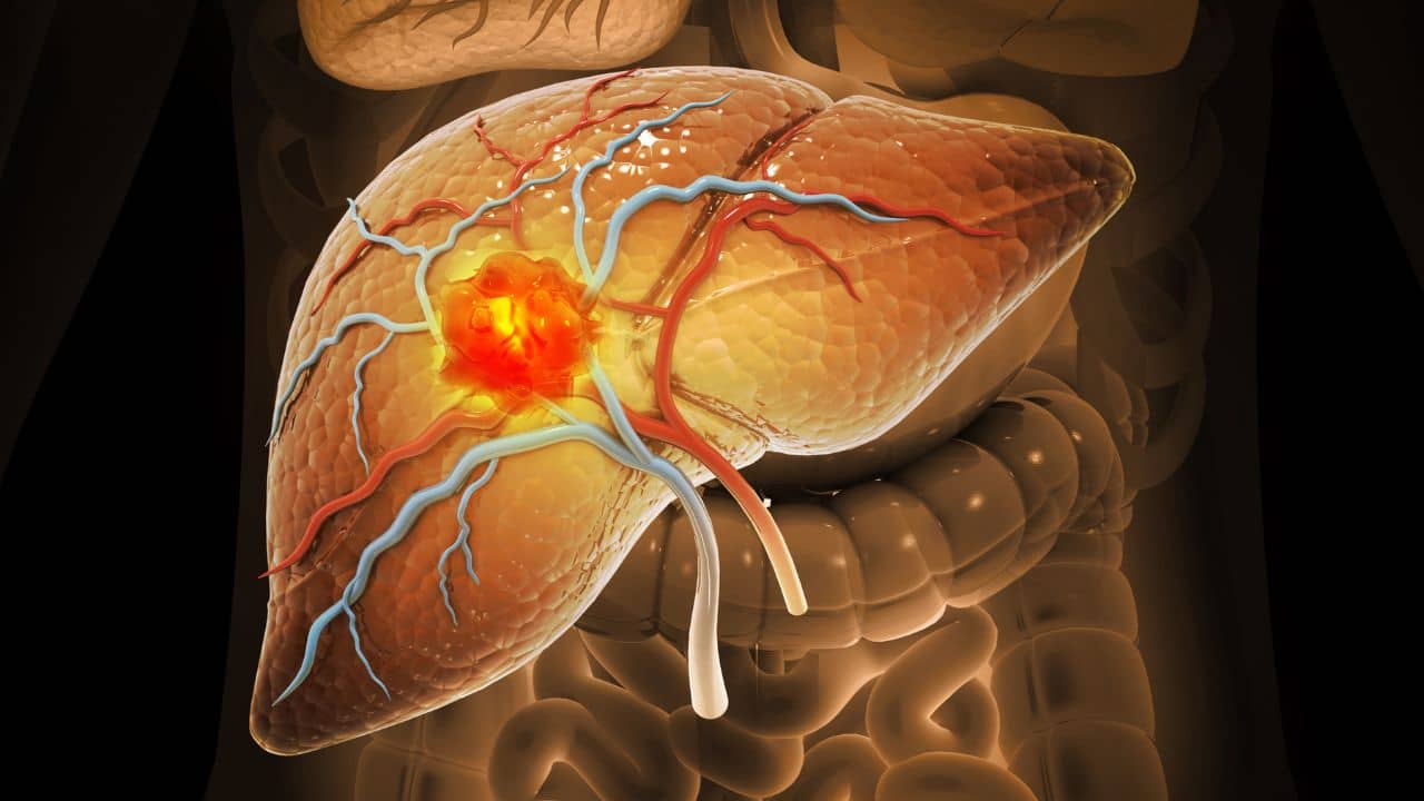 Liver Cancer: ফ্যাটি লিভার থেকেই হতে পারে মারাত্মক লিভার ক্যানসার! কীভাবে তার মোকাবিলা করবেন?