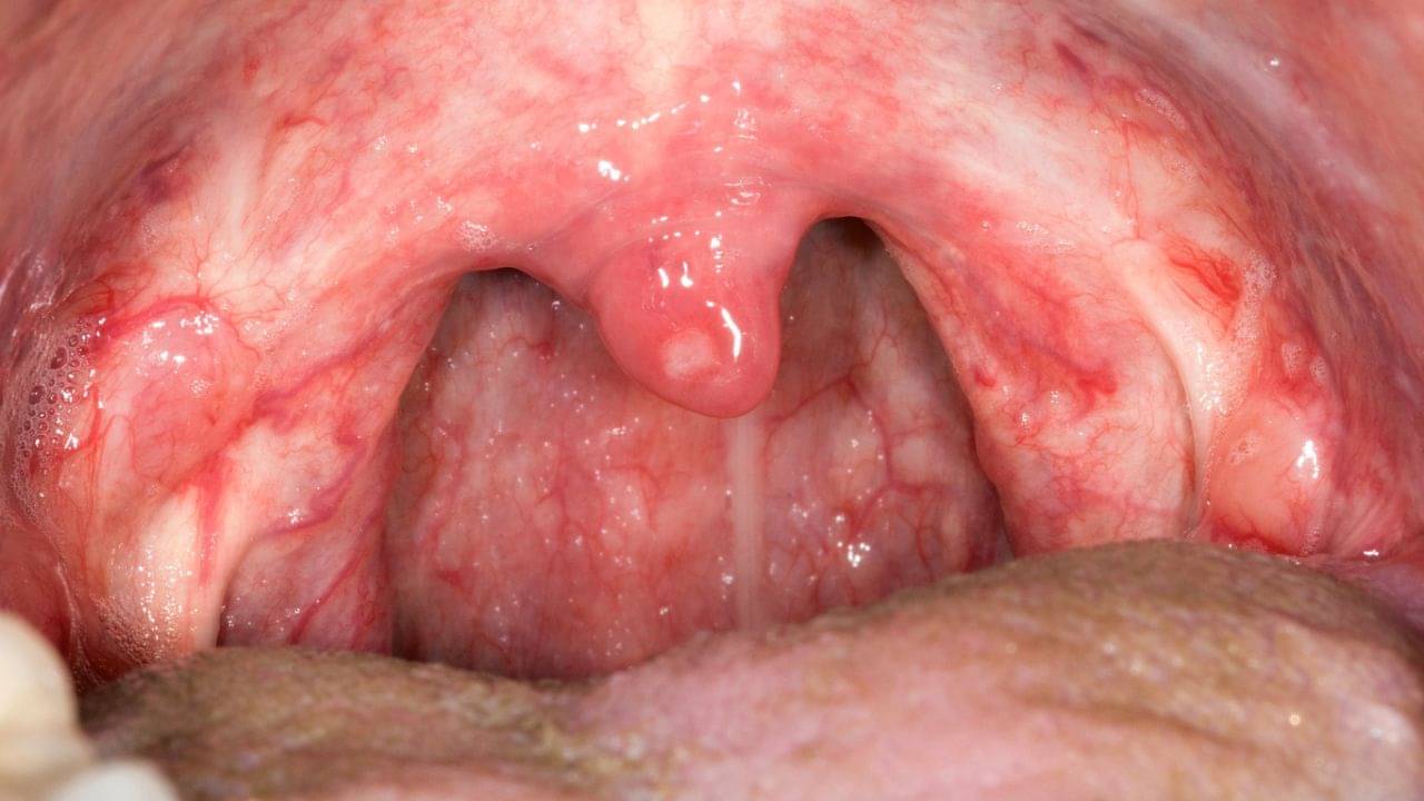 Pharyngitis: গলা ব্যথা মানেই কি ফ্যারেনজাইটিস নয়! বুঝবেন কীভাবে? কখন সতর্ক হবেন?