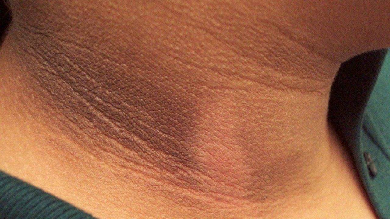 Dark Patches: ঘাড়ের কাছে কুচকুচে কালো দাগের জন্য অস্বস্তিতে পড়েন? এই ঘরোয়া উপায়েই মিলবে সমাধান