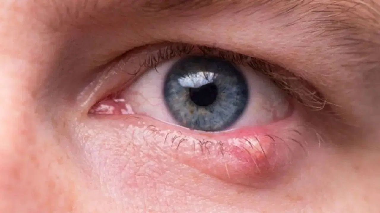 Eye Care Tips: চোখে কেন আঞ্জনি হয়? কী করলে মিলবে মুক্তি? Eye Care Tips: চোখে কেন আঞ্জনি হয়? কী করলে মিলবে মুক্তি?