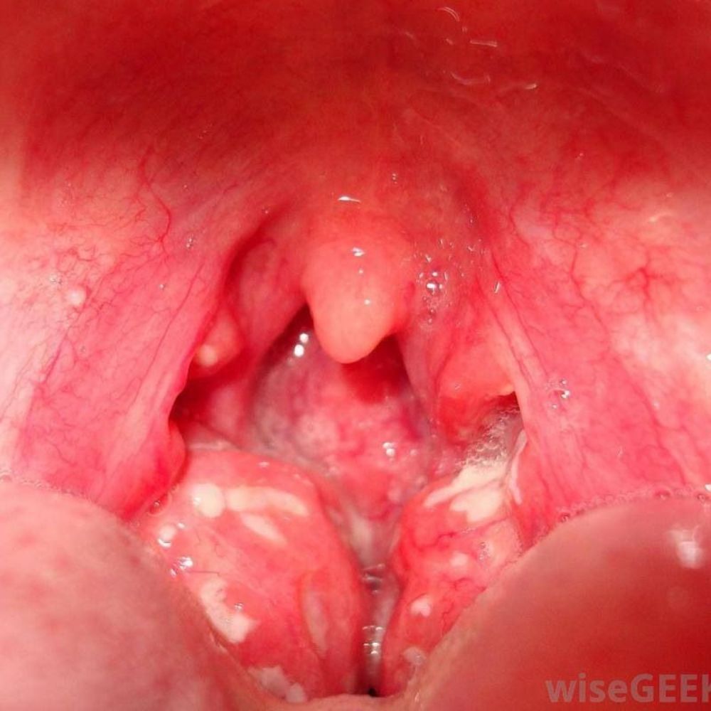 টনসিল হল জিভের পিছনের প্রান্তে গলার দু’পাশে গোলাকার পিণ্ড। এই টনসিল খেয়াল রাখে মুখ, নাক, গলা থেকে কোনও রোগজীবাণু যেন শরীরের ভেতর প্রবেশ করতে না পারে। (Credit - Pinterest) 
