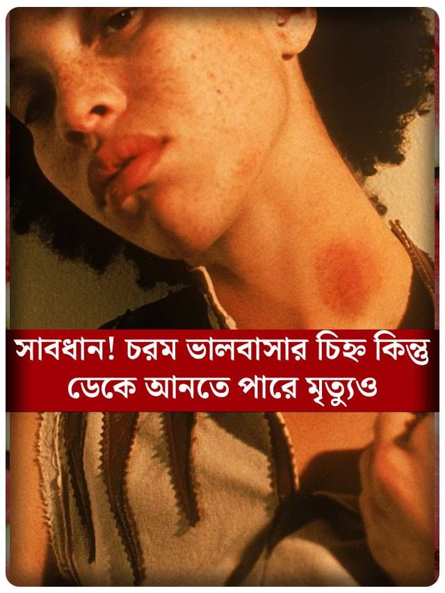 প্রেমের চিহ্ন রাখতে লাভ বাইট দিচ্ছেন? প্রেমিকার জীবনে  কোন বিপদ ডেকে আনছেন জানেন?