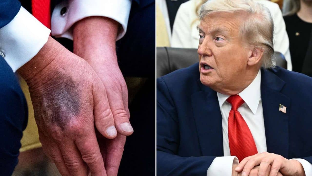 Donald Trump: ট্রাম্পের হাতে ওটা কীসের দাগ? মার্কিন প্রেসিডেন্টের শারীরিক অবস্থা কি সত্যি গুরুতর?