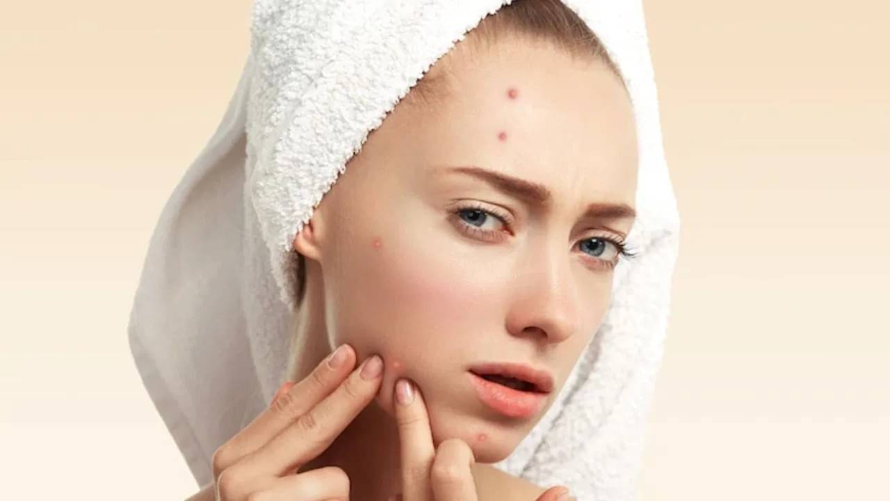 রসুনের রসেই এবার উধাও হবে ব্রণ, ৫ মিনিটে মিলবে স্বস্তি