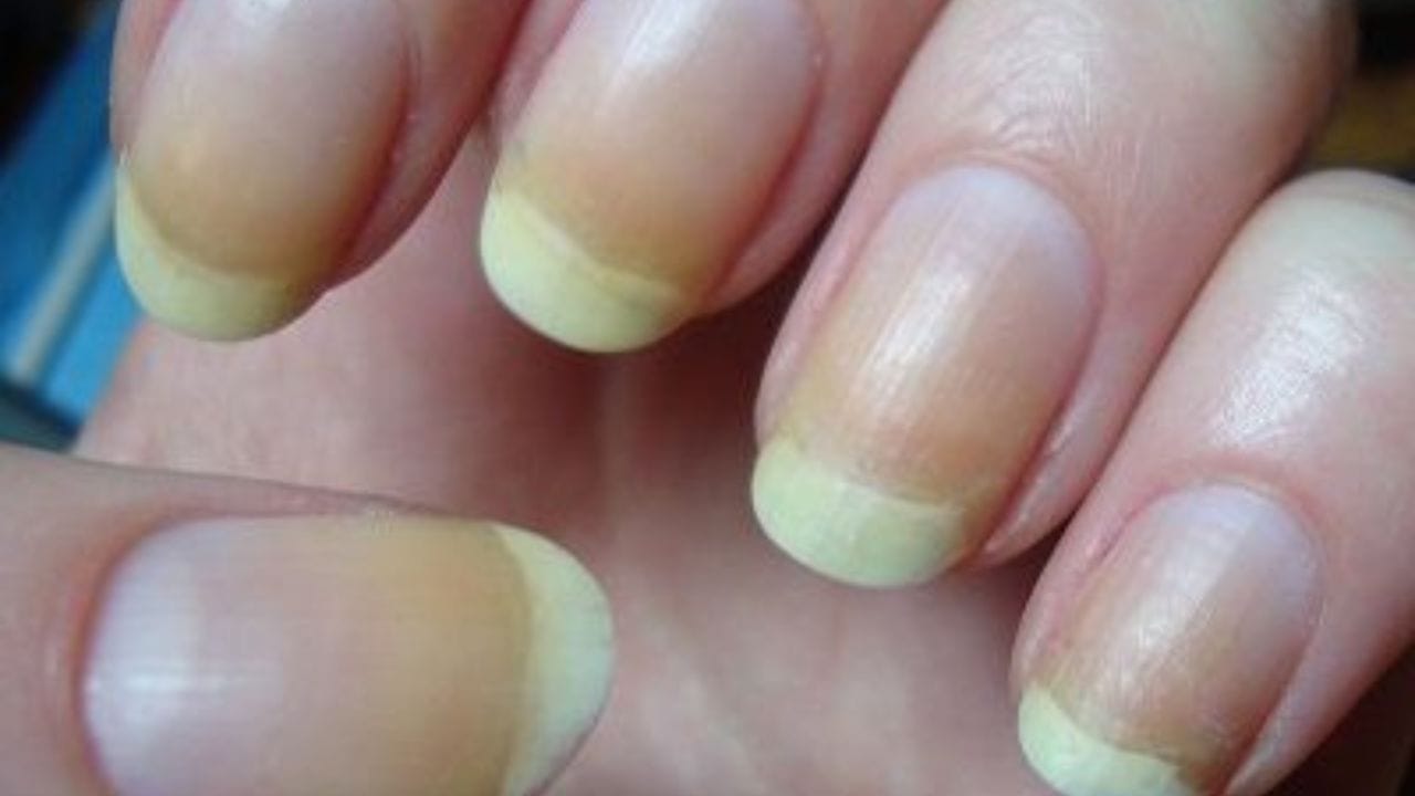 Yellow Nails: হলদেটে হয়ে গিয়েছে হাতের নখ? পুজোর আগেই পুরনো চেহারা ফেরাবেন কী করে? Yellow Nails: হলদেটে হয়ে গিয়েছে হাতের নখ? পুজোর আগেই পুরনো চেহারা ফেরাবেন কী করে?