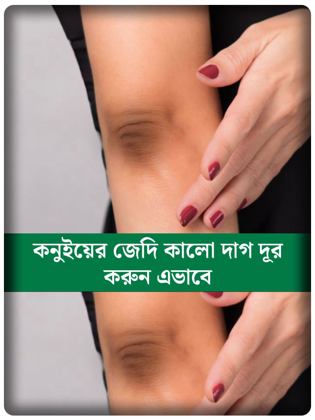আর নয় অস্বস্তি! কুচকুচে কালো কনুইয়ের দাগ ভ্যানিশ করার সেরা উপায় জানুন