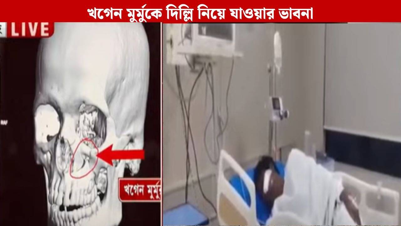 Attacked On Khagen Murmu: মুখে বসানো হতে পারে পাত, আপাতত কথা বলতে পারবেন না খগেন মুর্মু, দিল্লি নিয়ে যাওয়ার ভাবনা পরিবারের