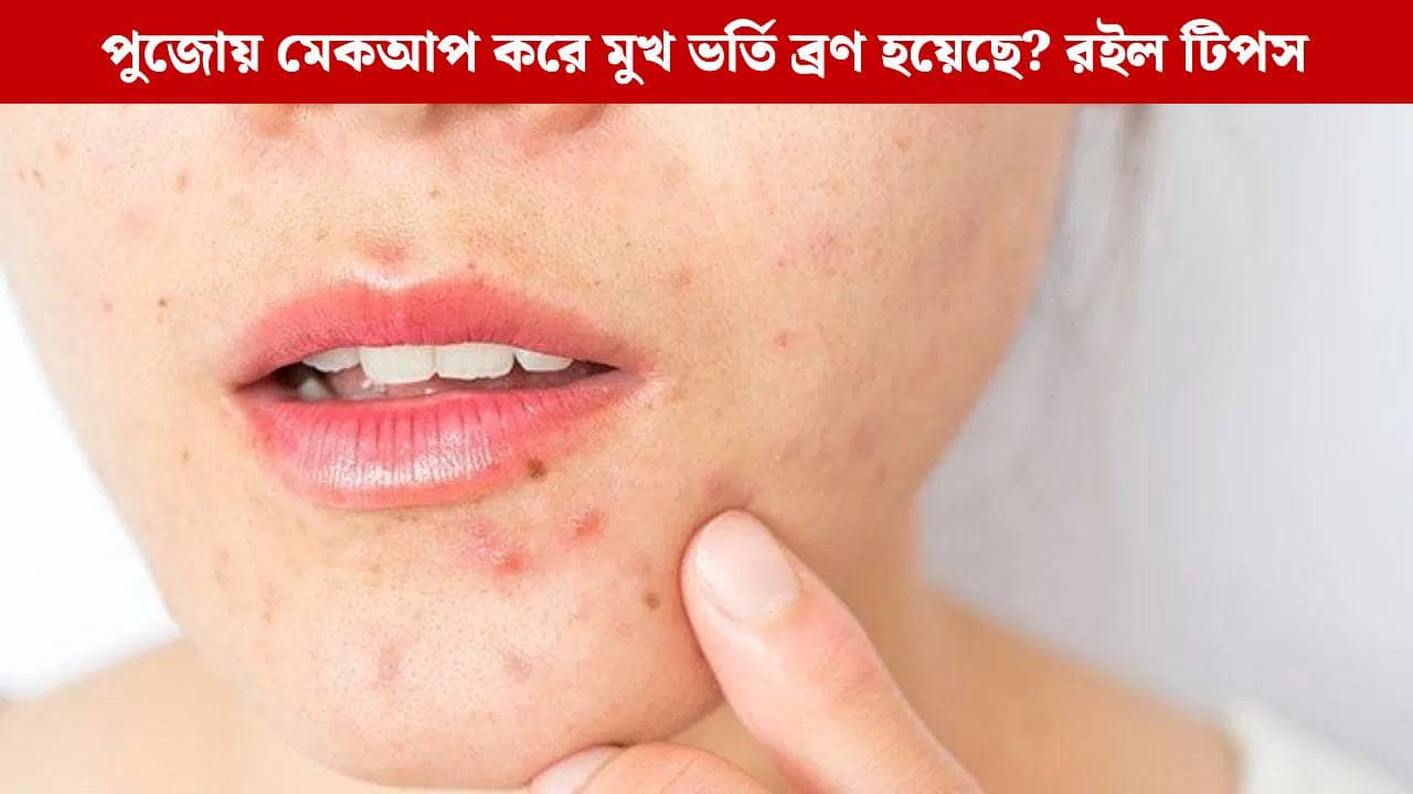 Pimples: পুজো শেষ হতেই সারা মুখে ব্রণ উঁকি মারছে? কীভাবে সমস্যার সমাধান করবেন?