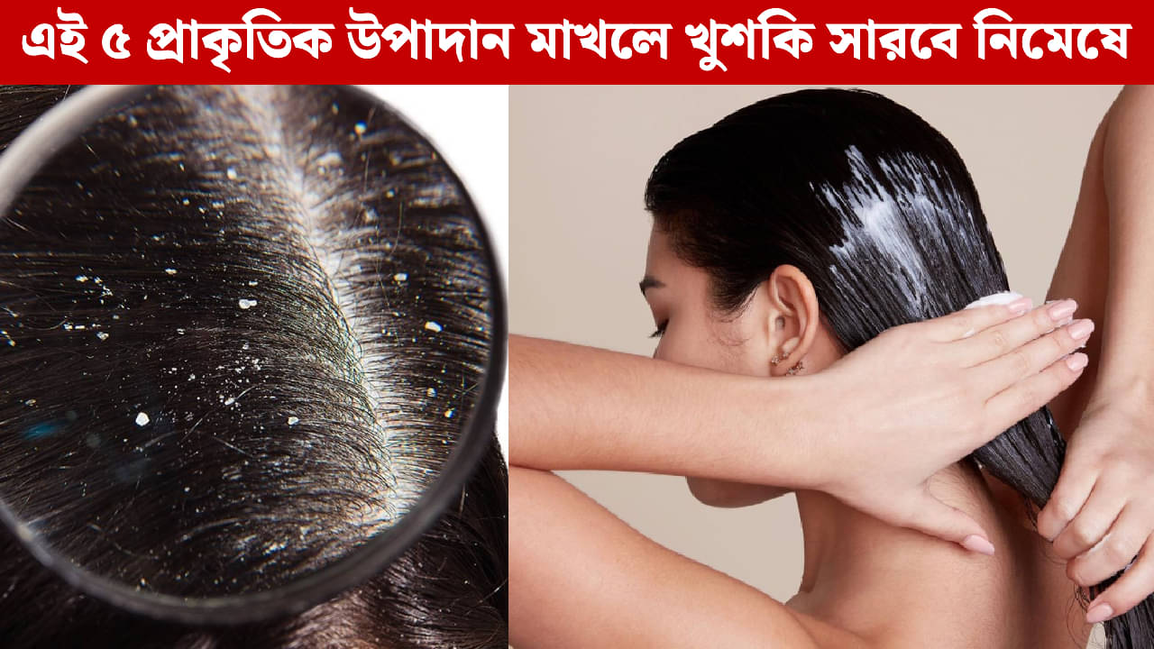 Dandruff Problem: খুশকির শত্রু, চুলের বন্ধু! রান্নাঘরের এই ৫ উপকরণে মাথা হবে ঝকঝকে