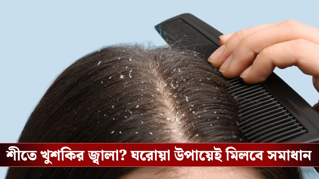 শীত এলেই খুশকির সমস্যা? তা দূর করার সহজ উপায় জেনে নিন শীত এলেই খুশকির সমস্যা? তা দূর করার সহজ উপায় জেনে নিন