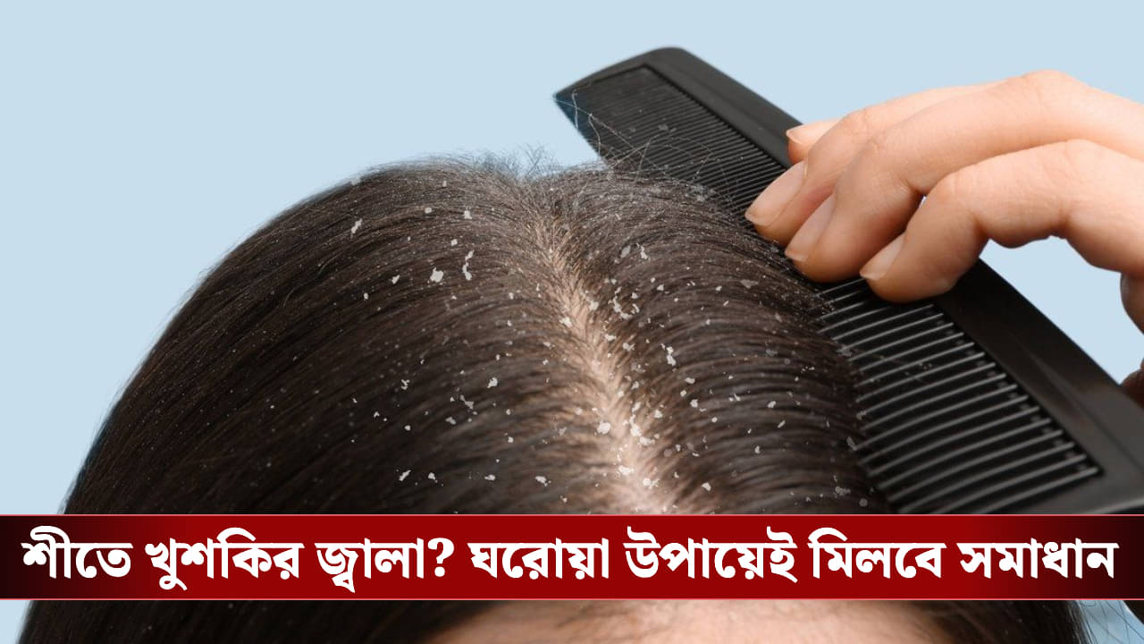 Dandruff Problem: শীত এলেই মাথায় খুশকির সমস্যা? জেনে নিন দূর করার সহজ উপায়