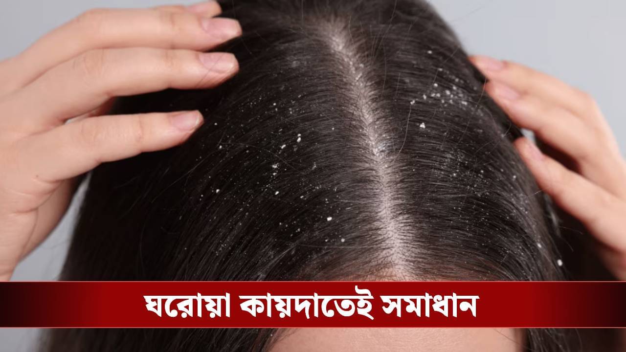 হাজার চেষ্টাতেও খুশকি যাচ্ছে না? এই এক নিয়মেই মাথা হবে পরিষ্কার