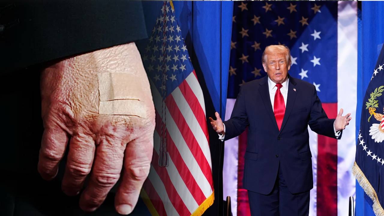 Donald Trump Hand Bandaged: 'কালশিটের দাগ...', ডান হাতে ব্যান্ডেজ! ট্রাম্প কি গুরুতর অসুস্থ? Donald Trump Hand Bandaged: 'কালশিটের দাগ...', ডান হাতে ব্যান্ডেজ! ট্রাম্প কি গুরুতর অসুস্থ?