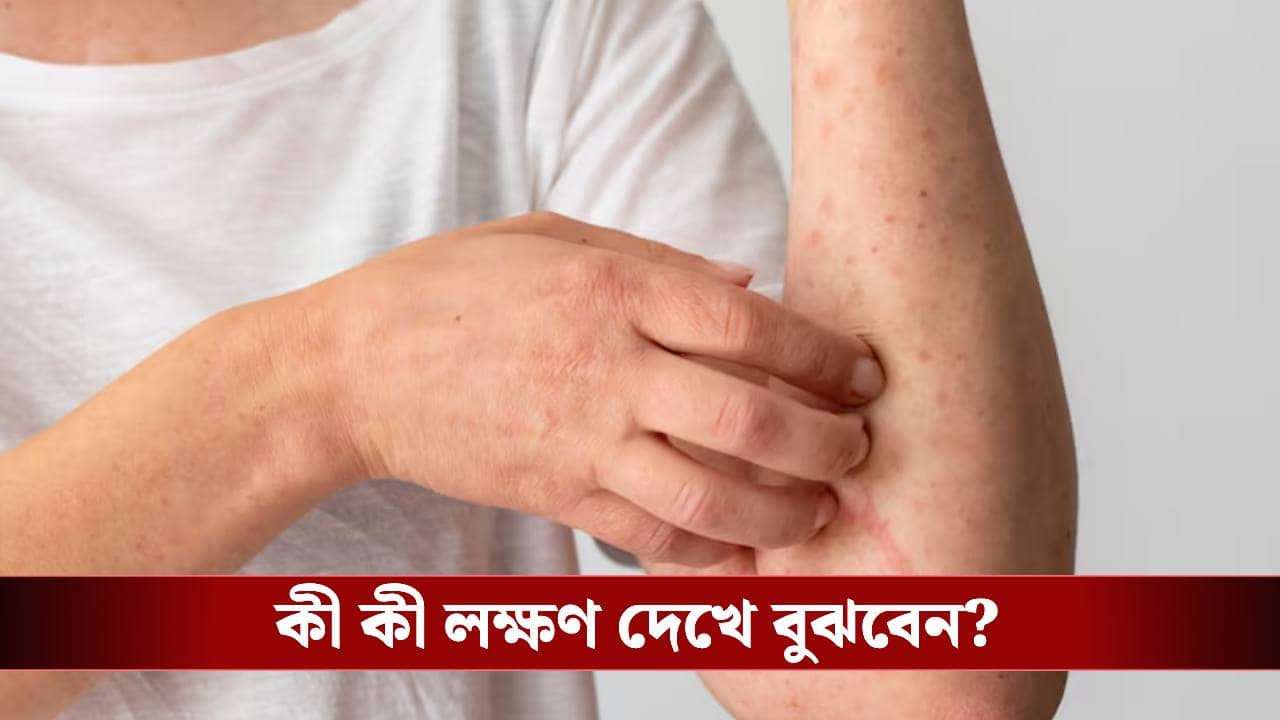 চিকেন পক্সের হাত থেকে বাঁচতে কী কী সতর্কতা জরুরি?