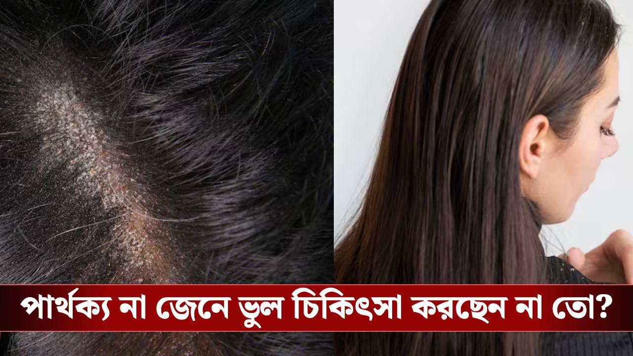 খুশকি ভেবে ড্রাই স্ক্যাল্পের চিকিৎসা করছেন না তো?