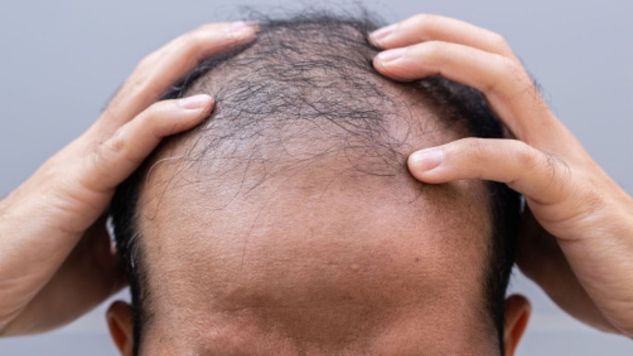 Hair Fall Solution: চুল নয়, পড়ছে আত্মবিশ্বাস? ট্যাঁকের কড়ি বাঁচিয়েই হবে টাকের সমাধান Hair Fall Solution: চুল নয়, পড়ছে আত্মবিশ্বাস? ট্যাঁকের কড়ি বাঁচিয়েই হবে টাকের সমাধান