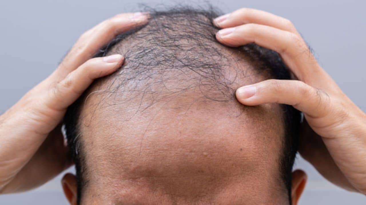 Hair Fall Solution: চুল নয়, পড়ছে আত্মবিশ্বাস? ট্যাঁকের কড়ি বাঁচিয়েই হবে টাকের সমাধান