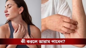 ঘামাচি আর র‍্যাশের জ্বালায় অতিষ্ঠ? ভরসা রাখুন এই ঘরোয়া টোটকায়
