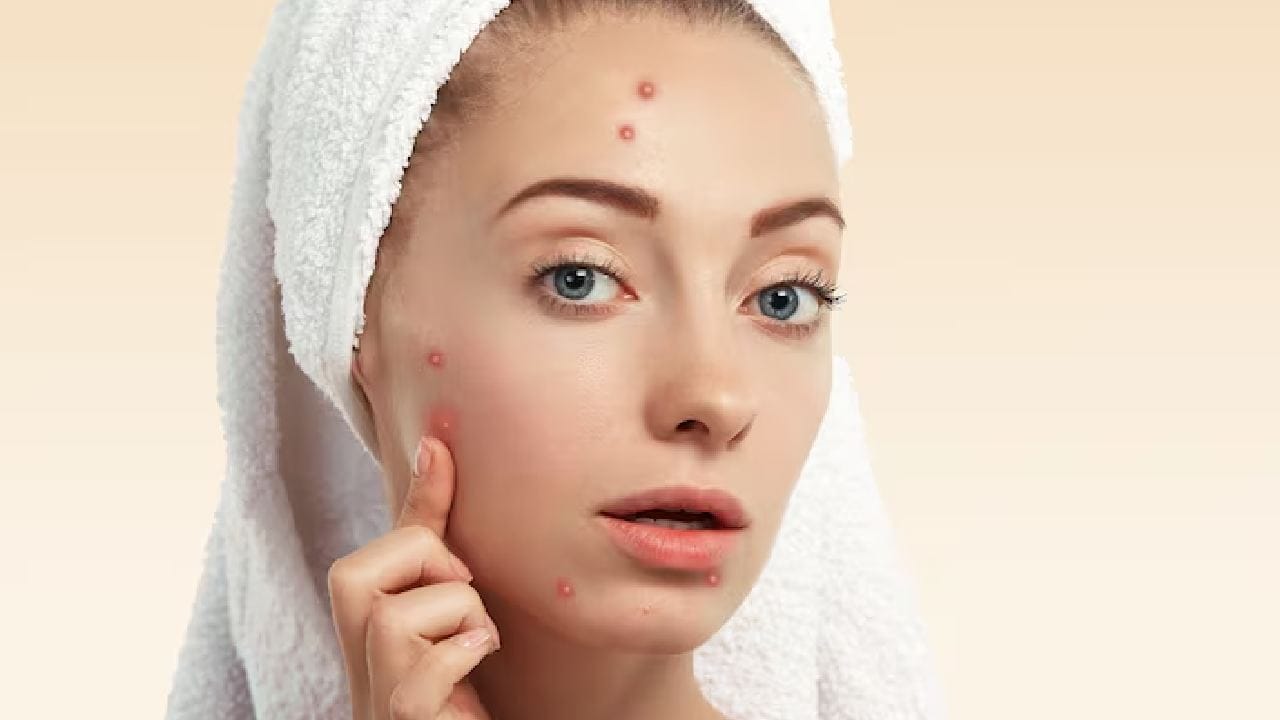 যাঁদের ত্বক তৈলাক্ত, তাঁদের ক্ষেত্রে এটি কিছুটা উপকারে আসতে পারে। এর অ্যান্টি-ব্যাকটেরিয়াল গুণ ব্রণের জীবাণু মারতে সাহায্য করতে পারে। তবে হরমোনজনিত ব্রণের ক্ষেত্রে এটি একেবারেই কাজ করবে না। Free Pik