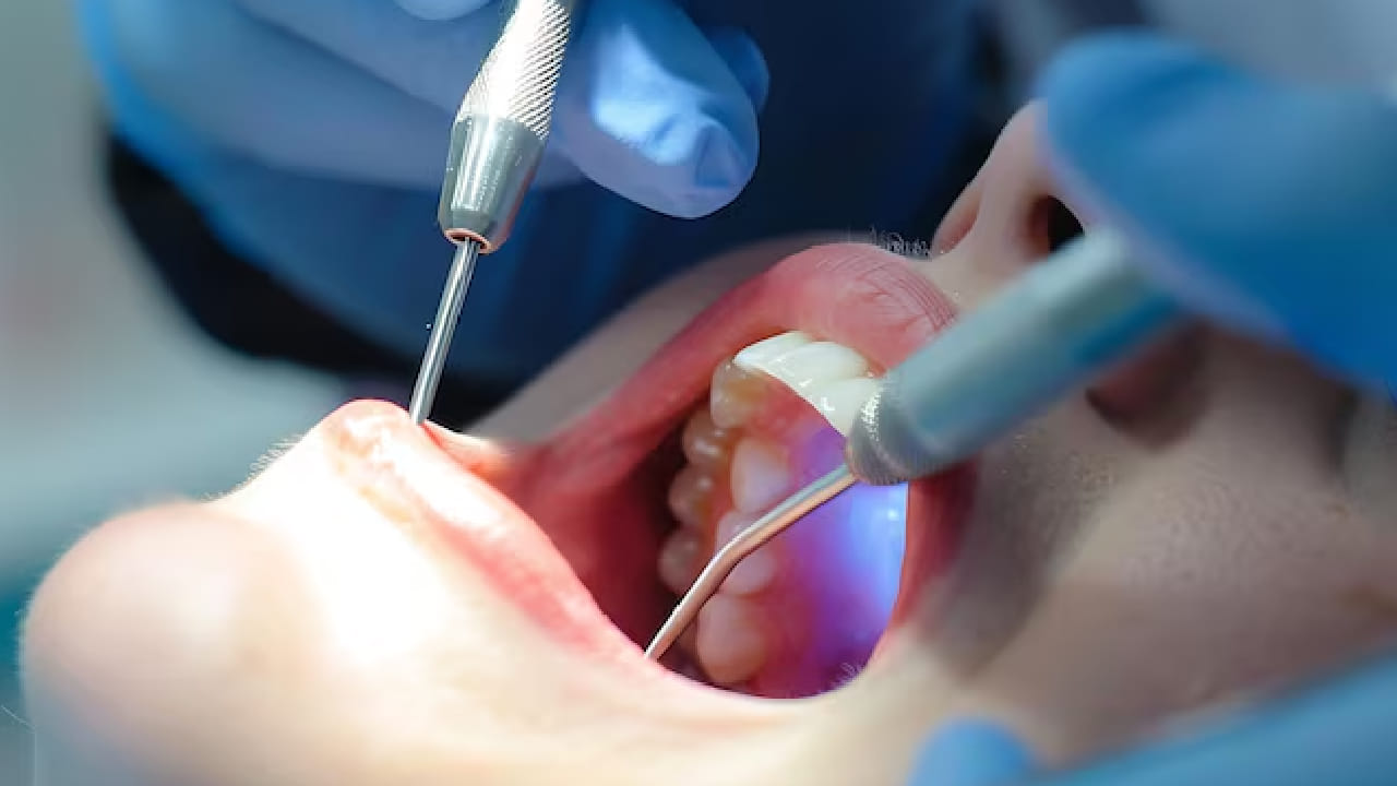 অনেকেই মনে করেন দাঁতের চিকিৎসা মানেই বিপুল খরচ ও ঝক্কি। অথচ শুরুতে একটি ছোট ক্যাভিটি ভরাট করলে যে খরচ হয়, অবহেলার কারণে সেই দাঁতে রুট ক্যানাল বা ইমপ্ল্যান্ট করাতে গেলে খরচ বহুগুণ বেড়ে যায়। Free pik