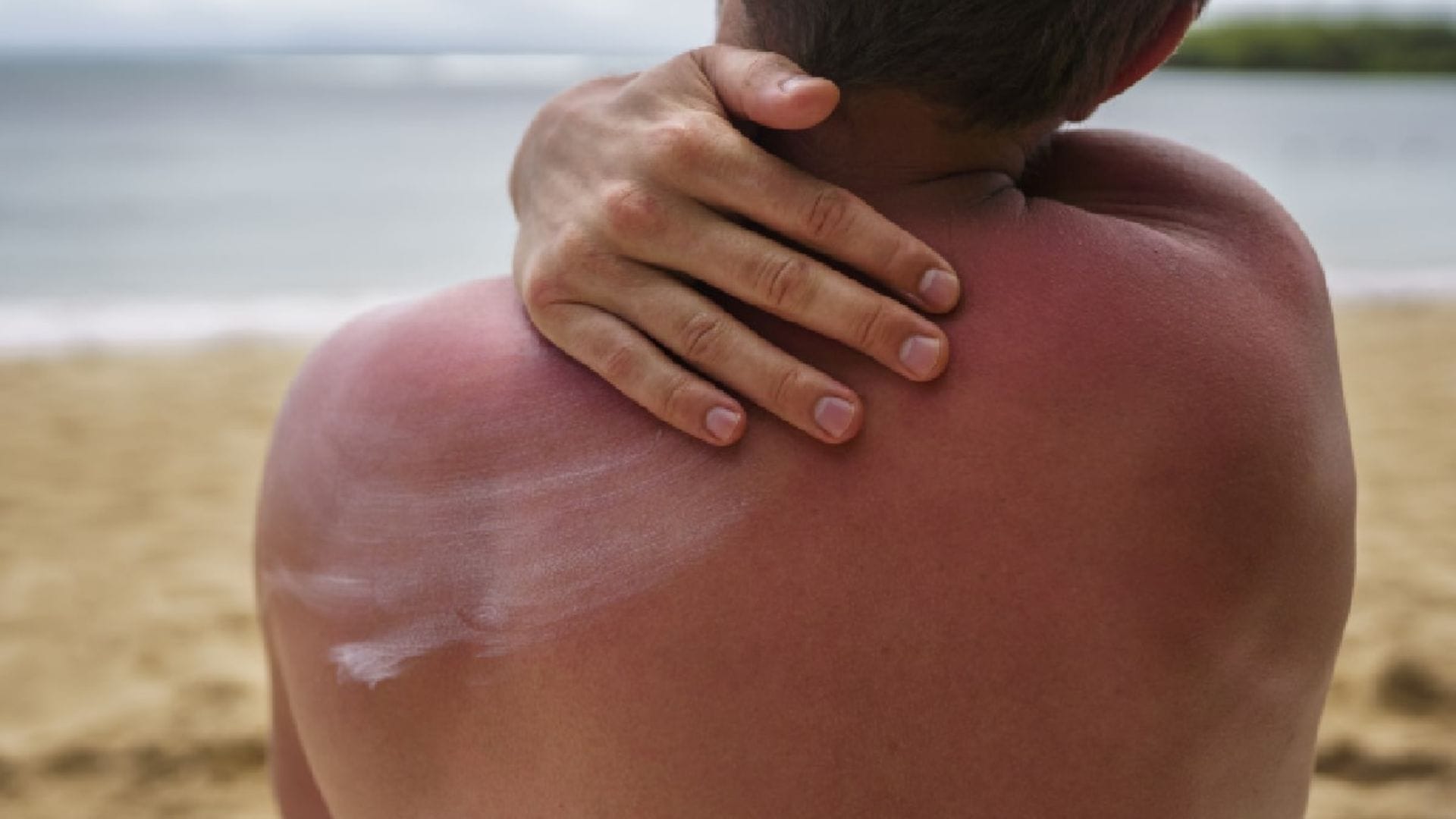 বেসন ও টক দইয়ের মিশ্রণ ত্বকের রোমকূপ পরিষ্কার রাখতে সাহায্য করে। এই মিশ্রণটি লাগিয়ে কিছুক্ষণ পর ধুয়ে ফেললে ঘামাচির উপদ্রব কমে।