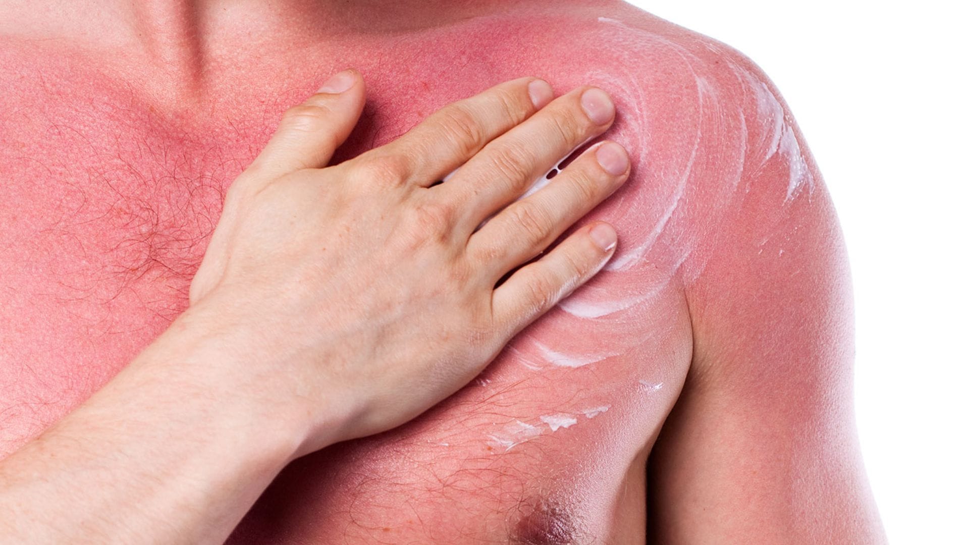 মুলতানি মাটির সাথে গোলাপ জল মিশিয়ে একটি প্যাক তৈরি করুন। এটি ঘামাচির ওপর লাগিয়ে ১৫ মিনিট রেখে ধুয়ে ফেলুন। এটি ত্বকের অতিরিক্ত তেল ও ময়লা শুষে নেয়।