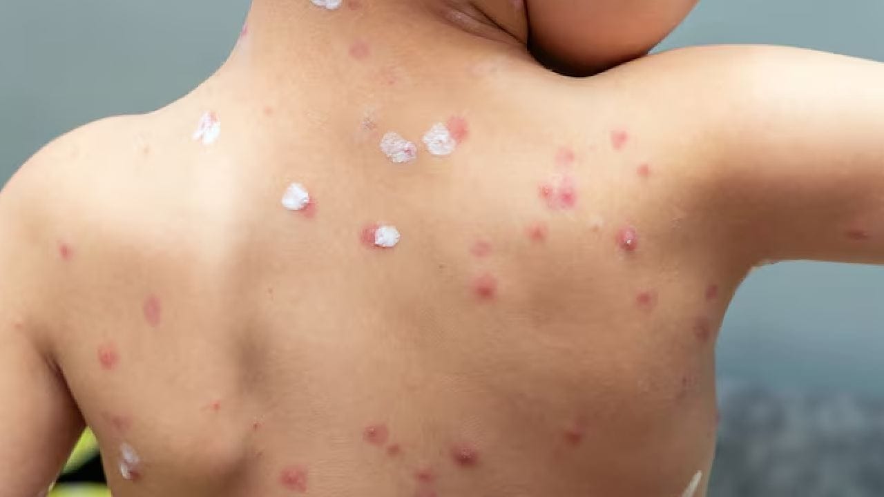 হাম বা পক্স হলে শরীর থেকে প্রচুর পরিমাণে জল ও তরল বেরিয়ে গিয়ে জলশূন্যতা তৈরি হয়। ভাইরাসের দাপটে শরীরে ভিটামিন এ, সি, জিঙ্ক ও প্রোটিনের প্রবল ঘাটতি দেখা দিতে পারে। এর ফলে শিশুদের রোগ প্রতিরোধ ক্ষমতাও অনেকটা কমে যায়। free pik