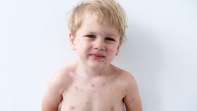 হাম ও পক্স থেকে দ্রুত সুস্থ হতে ডায়েটে রাখুন এই বিশেষ পথ্যগুলি