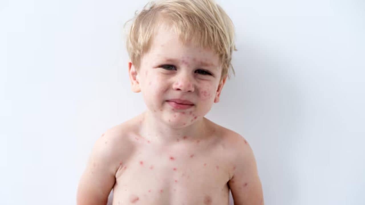 হাম ও পক্সে ভুগছে শিশু? দ্রুত সুস্থ করতে ডায়েটে রাখুন এই বিশেষ পথ্যগুলি