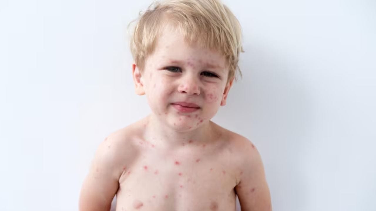 হাম ও পক্সে ভুগছে শিশু? দ্রুত সুস্থ করতে ডায়েটে রাখুন এই বিশেষ পথ্যগুলি হাম ও পক্সে ভুগছে শিশু? দ্রুত সুস্থ করতে ডায়েটে রাখুন এই বিশেষ পথ্যগুলি